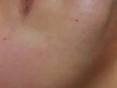 Epilazione laser — dopo il trattamento, dettaglio originale