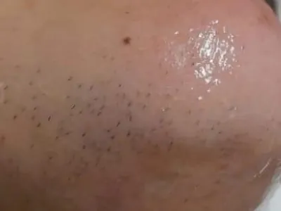 Epilazione laser — prima del trattamento, dettaglio originale